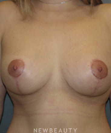 dr-sean-simon-breast-augmentation-breast-lift-liposuction-tummy-tuck-b