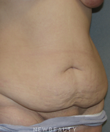 dr-sean-simon-breast-augmentation-breast-lift-liposuction-tummy-tuck-b