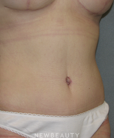 dr-sean-simon-breast-augmentation-breast-lift-liposuction-tummy-tuck-b