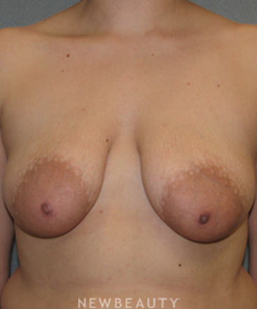 dr-sean-simon-breast-augmentation-breast-lift-b