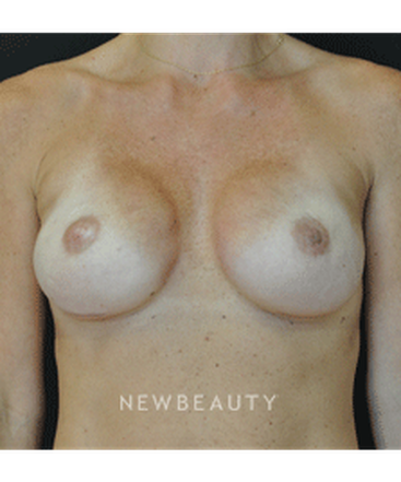 dr-andrew-smith-breast-reconstruction-b