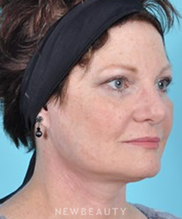 dr-brad-bengtson-facelift-b