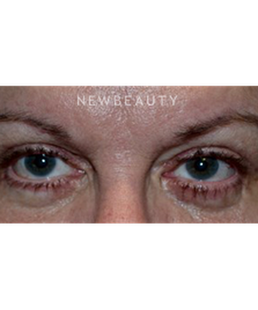 dr-baljeet-k-purewal-blepharoplasty-b