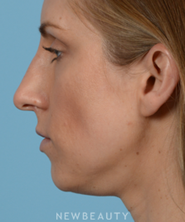 dr-jeffrey-wise-rhinoplasty-b