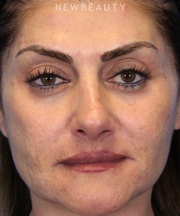 dr-ava-shamban-facial-rejuvenation-b