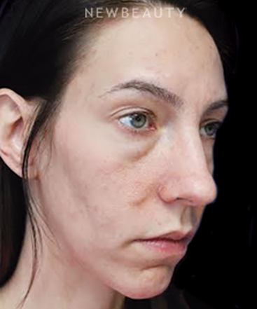 dr-joseph-russo-under-eye-rejuvenation-b