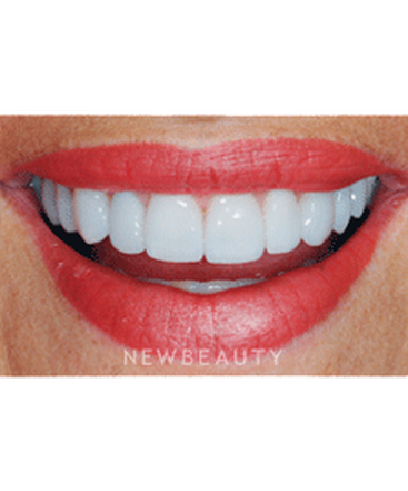 dr-ronald-goldstein-smile-makeover-invisalign-crowns-whitening-veneers-b