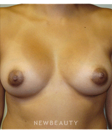 dr-sanjay-grover-breast-augmentation-b