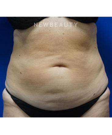 dr-niki-christopoulos-tummy-tuck-b