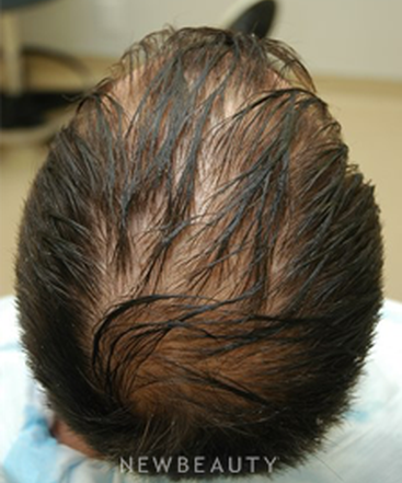 dr-jeffrey-rapaport-hair-transplant-b