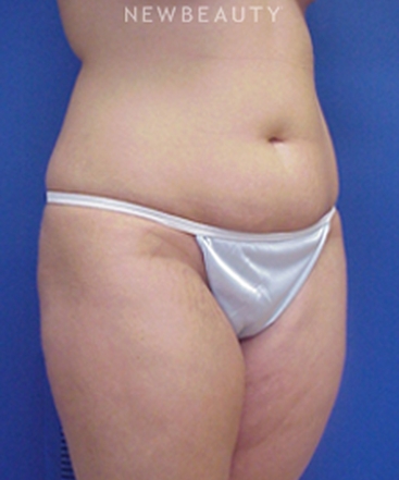 dr-joseph-russo-fit-and-trim-results-b