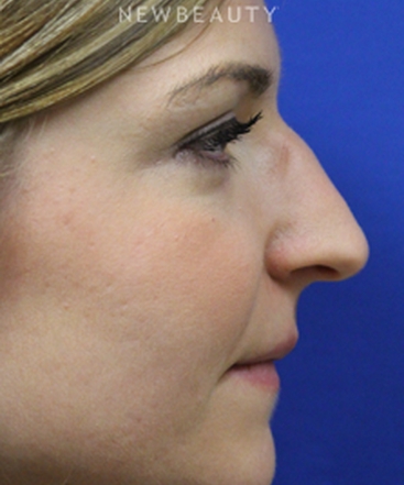 dr-jennifer-m-levine-revision-rhinoplasty-b