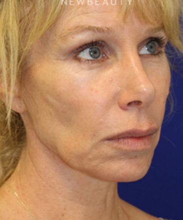 dr-dilip-madnani-mini-facelift-b