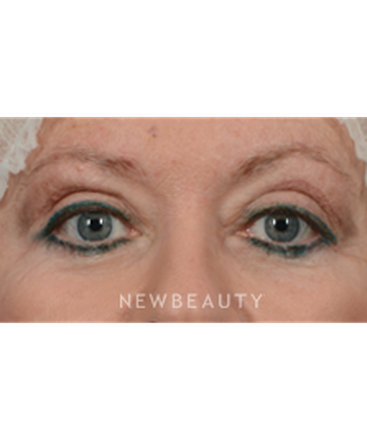dr-jeffrey-wise-facelift-b
