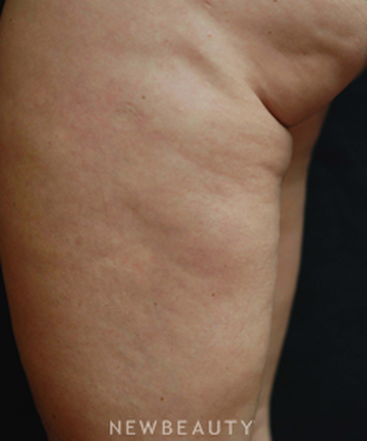 dr-kenneth-beer-lasers-cellulite-treatment-b