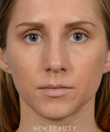 dr-jeffrey-wise-rhinoplasty-b