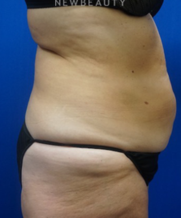 dr-niki-christopoulos-tummy-tuck-b