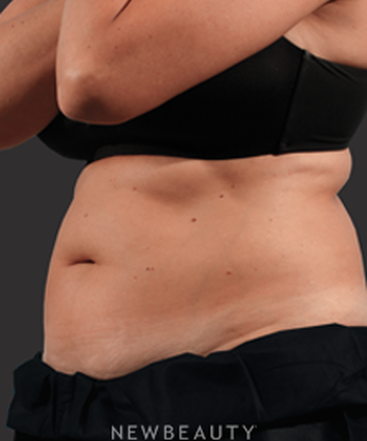 dr-marina-peredo-fat-melters-coolsculpting-b