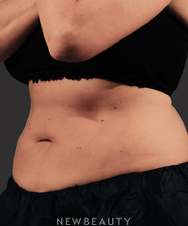 dr-marina-peredo-fat-melters-coolsculpting-b