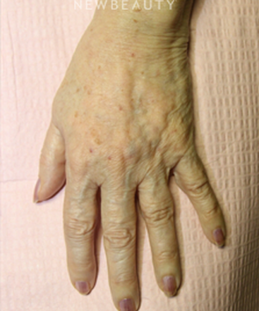 dr-jennifer-levine-lasers-b