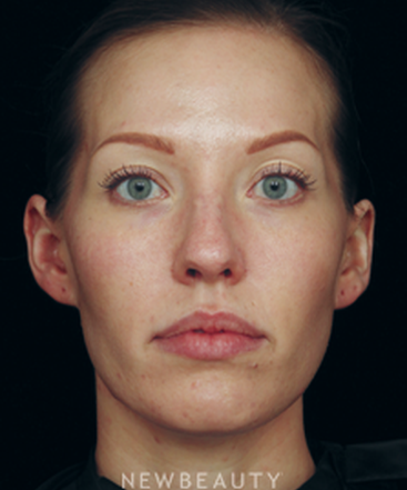 dr-jennifer-segal-browlift-cheek-augmentation-lip-enhancement-non-surgical-rhinoplasty-b