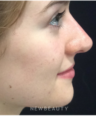 dr-kim-nichols-nonsurgical-rhinoplasty-b