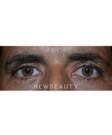 dr-baljeet-purewal-upper-blepharoplasty-b