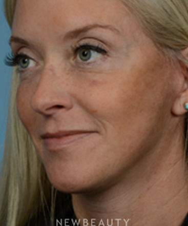 dr-jeffrey-wise-lower-facelift-b