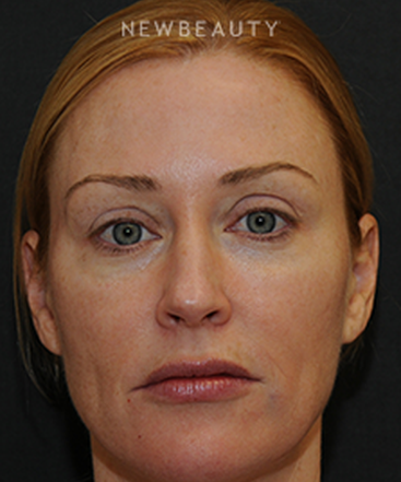 dr-janet-allenby-injectables-fillers-b