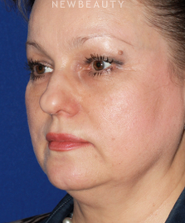 dr-konstantin-vasyukevich-facelift-b