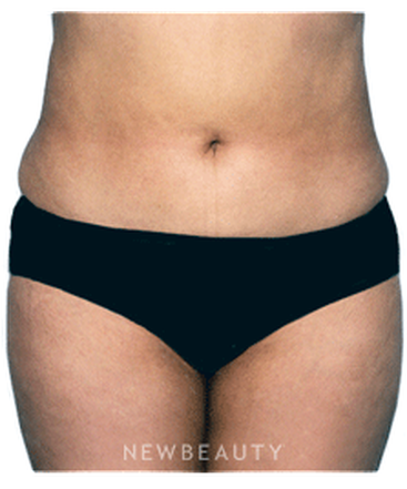 dr-david-rapaport-liposuction-b