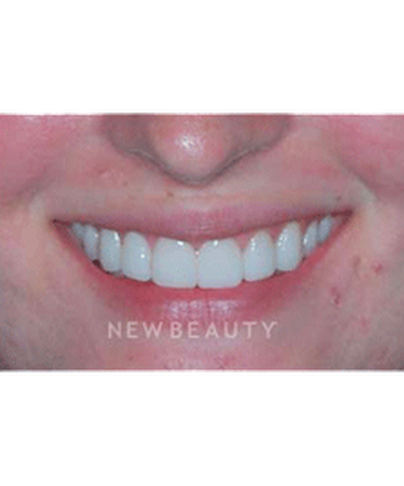 dr-guy-lewis-veneers-b