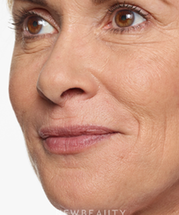 dr-marina-peredo-lip-enhancement-b
