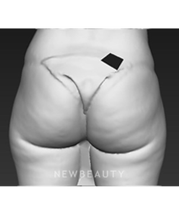 dr-brad-bengtson-cellulite-treatment-b