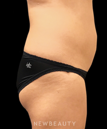 dr-janet-allenby-coolsculpting-b
