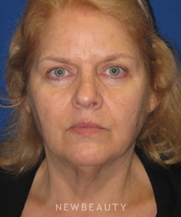 dr-dilip-d-madnani-facelift-necklift-b