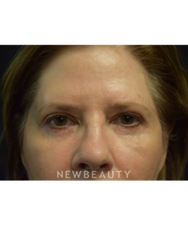 dr-jeffrey-b-wise-blepharoplasty-b