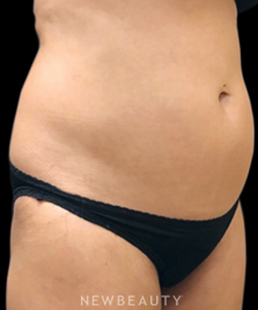 dr-janet-allenby-coolsculpting-b
