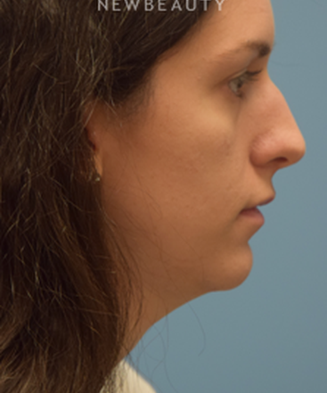 dr-jeffrey-wise-rhinoplasty-b