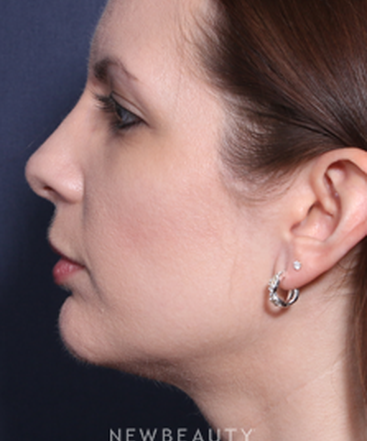 ljcsc-dr-wheeler-rhinoplasty-b