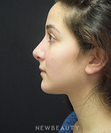 dr-jeffrey-b-wise-rhinoplasty-b