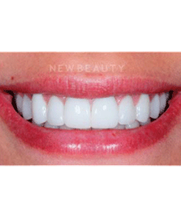 dr-guy-lewis-veneers-b