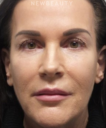 dr-marina-peredo-facelift-b