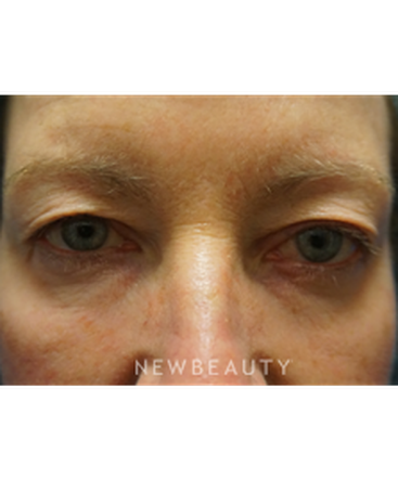 dr-niki-christopoulos-upper-blepharoplasty-b