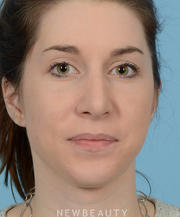 dr-jeffrey-wise-rhinoplasty-b