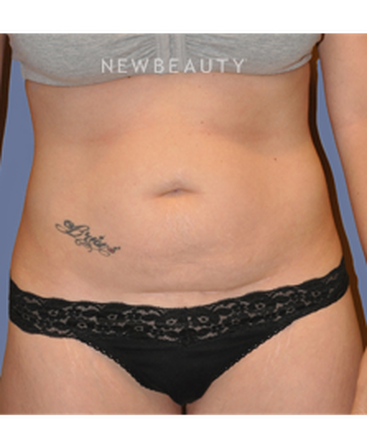 dr-bryan-w-gawley-tummy-tuck-b