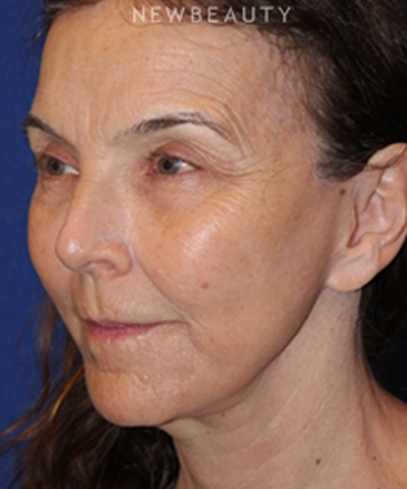 dr-dilip-madnani-facelift-necklift-b