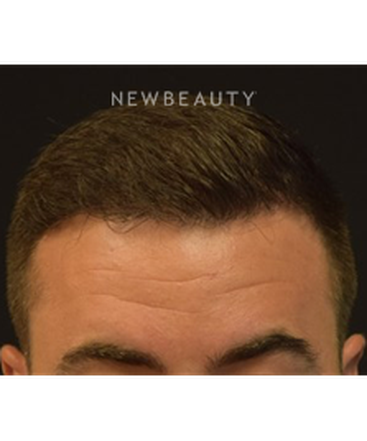 dr-jeffrey-rapaport-hair-transplant-b