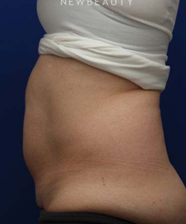 dr-jennifer-levine-sculpsure-b