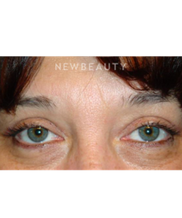dr-baljeet-k-purewal-upper-blepharoplasty-b